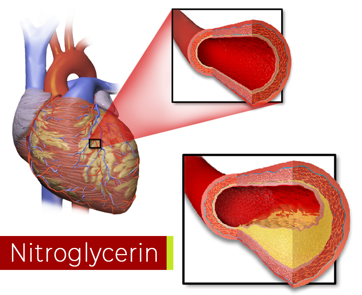 nitroglycerin does not relieve chest pain
