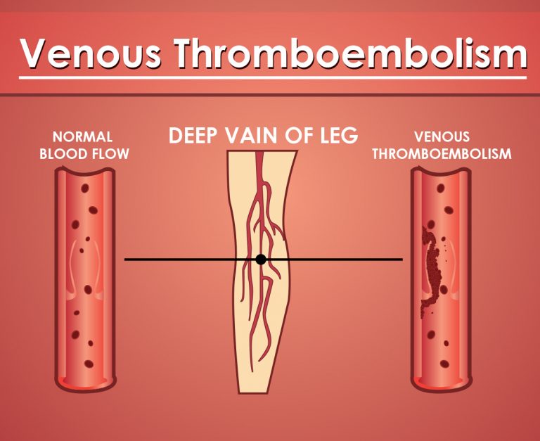 Se puede tener una trombosis estando anticoagulado